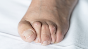 What Causes Hammertoe