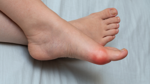 What Is a Bunion What Is a Bunion?