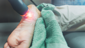 Laser Treatment For Foot Neuropathy