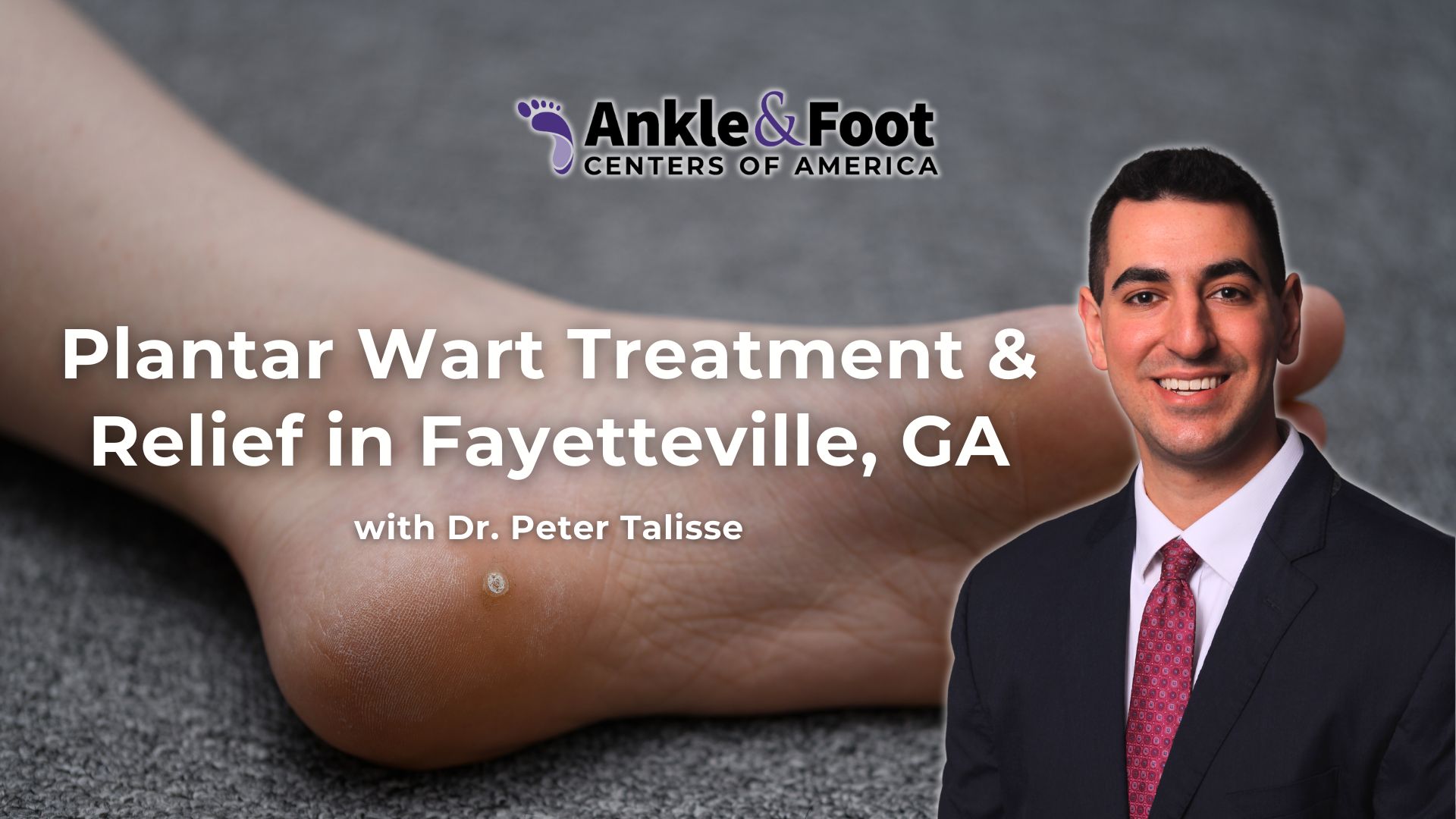 Plantar Wart Treatment Fayetteville GA