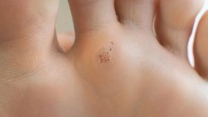 Plantar Wart Vs Callus