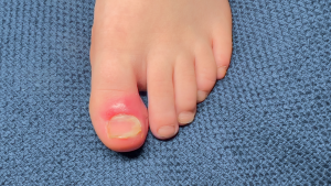 Infected Ingrown Toenail Infected Ingrown Toenail