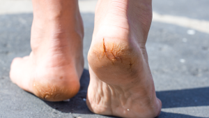 Causes of Plantar Warts