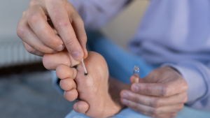 Plantar Warts Treatment