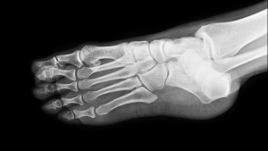 Ankle & Foot Centers of America | Relief for Ankle Sprains and Fractures in Canton Xray Types of Fractures