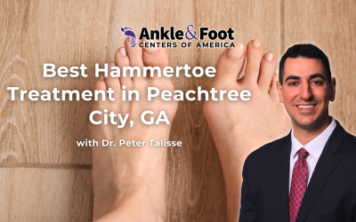 Best Hammertoe Treatment in Peachtree City, GA