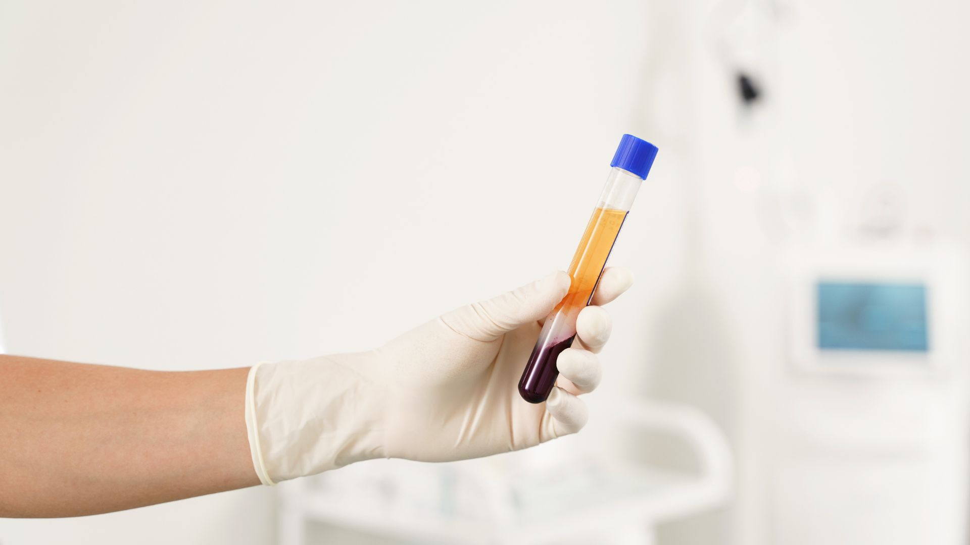 PRP Treatment