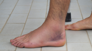 Ankle Sprain Recovery Time