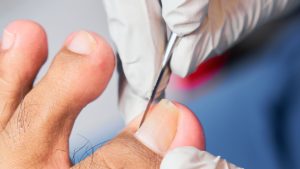 Foot Doctor for an Ingrown Toenail