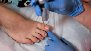 Nail Fungus