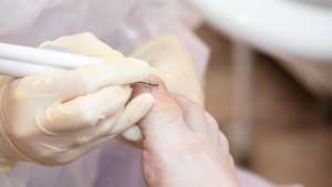 Nail Fungus Treatment