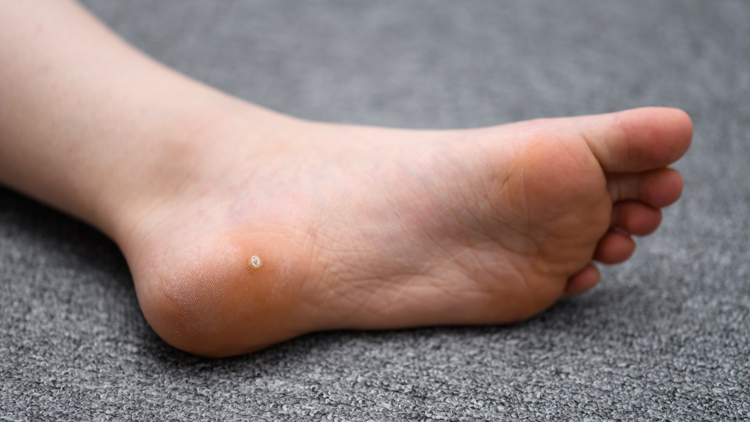 Plantar Wart Treatment