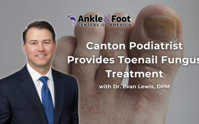 Canton Podiatrist Provides Toenail Fungus Treatment
