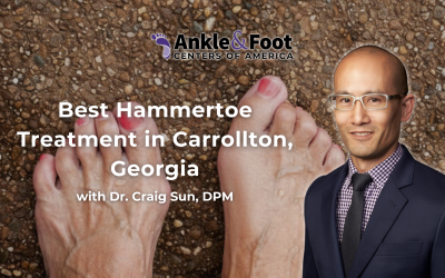 Best Hammertoe Treatment in Carrollton, Georgia