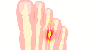 | What Is Morton's NeuromaWhat Is Morton’s Neuroma What Is Morton's Neuroma