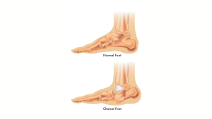 Charcot Foot Disease