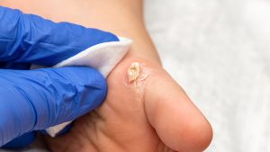 | Professional Plantar Warts Treatment OptionsProfessional Plantar Warts Treatment Options Professional Plantar Warts Treatment Options