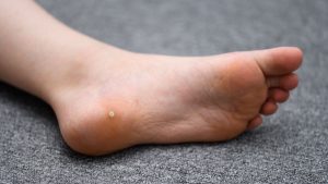 | What Are Plantar Warts?What Are Plantar Warts What Are Plantar Warts?