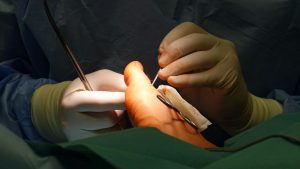 Bunion Surgery