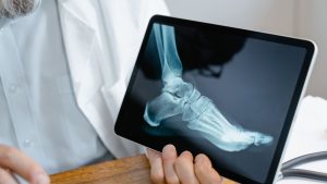 Bunion Treatment Options
