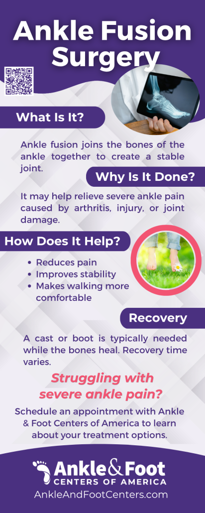 Ankle Fusion Surgery Infographic