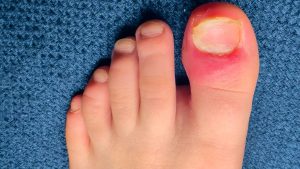 Common Ingrown Toenail Symptoms