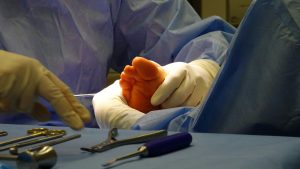 What Is Minimally Invasive Bunion Surgery