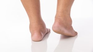 What Causes Gout in the Ankle?